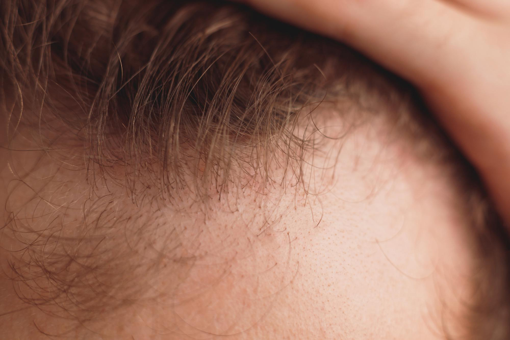 Hair Transplant With Pain Free